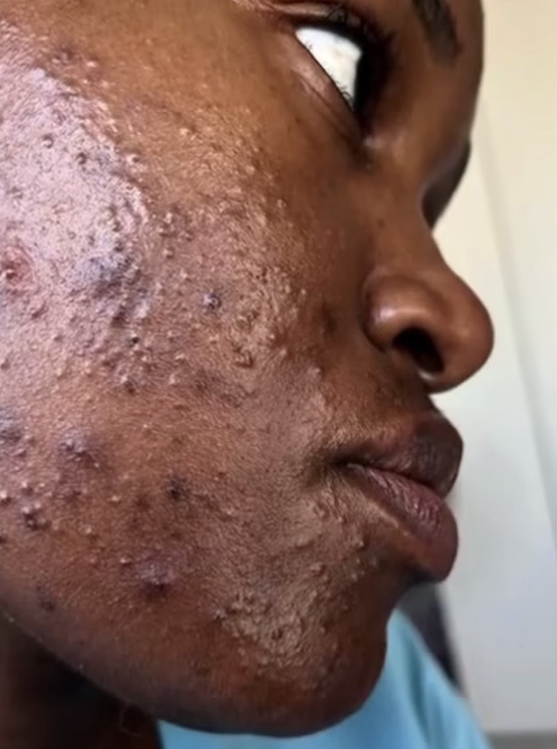Acne & Breakouts