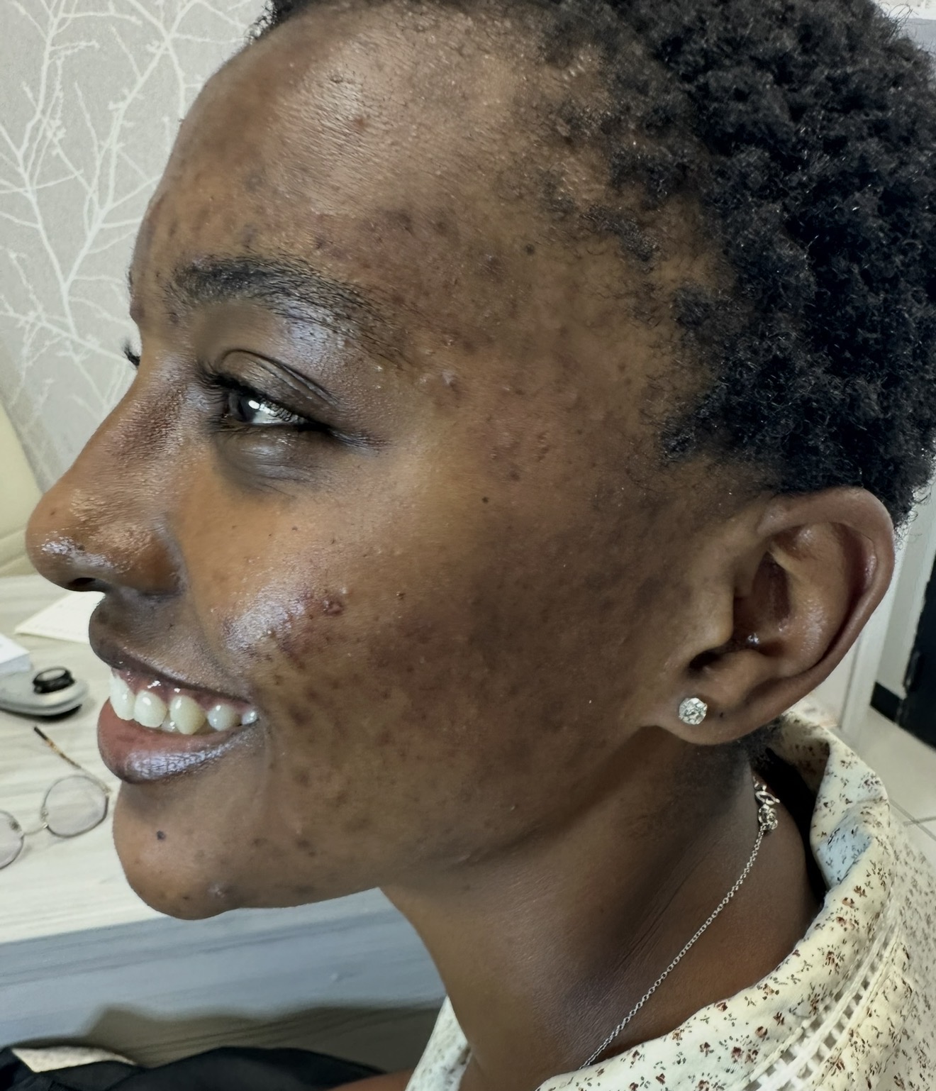 Acne Scarring & Texture