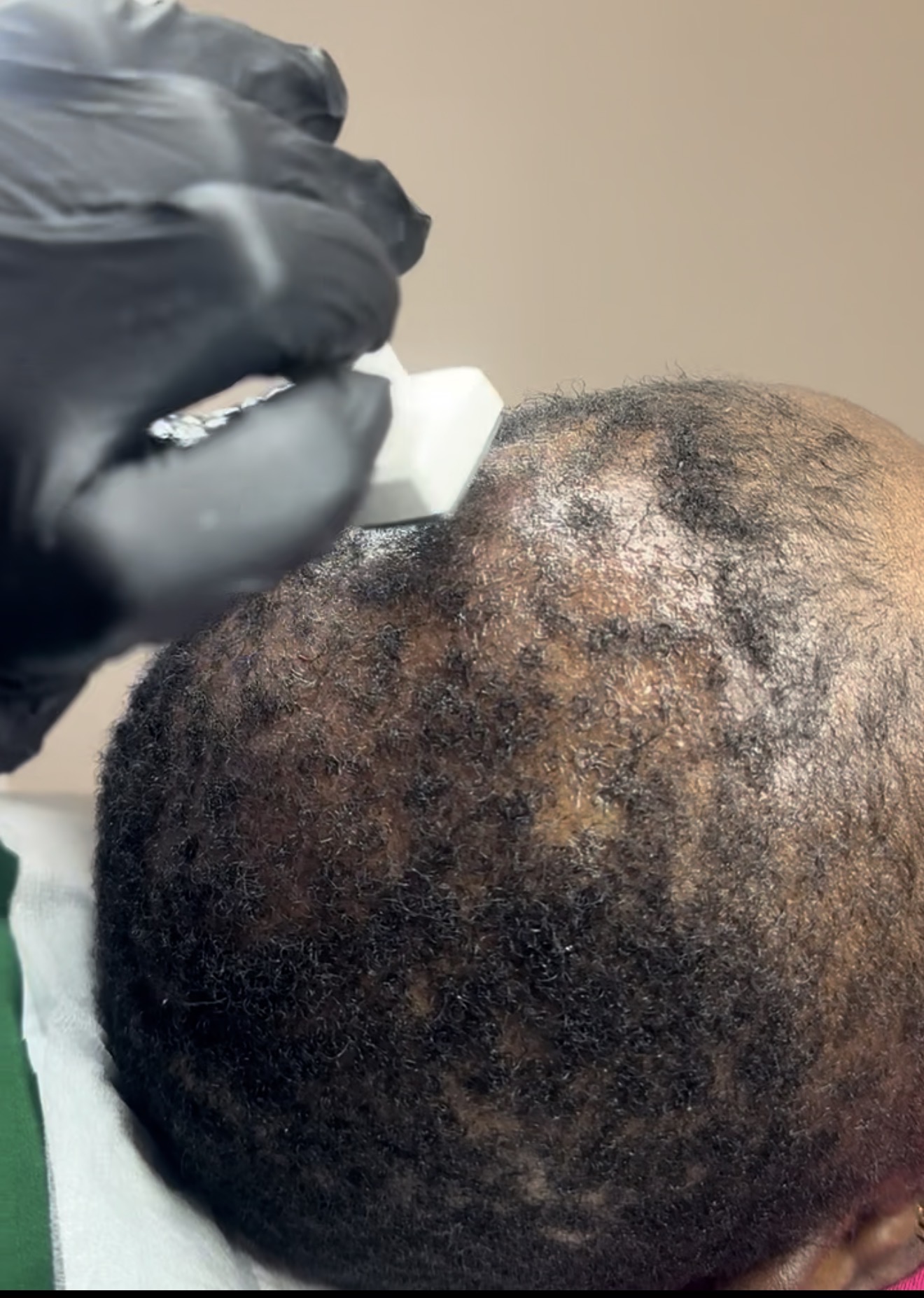 Hair Thinning & Scalp Health