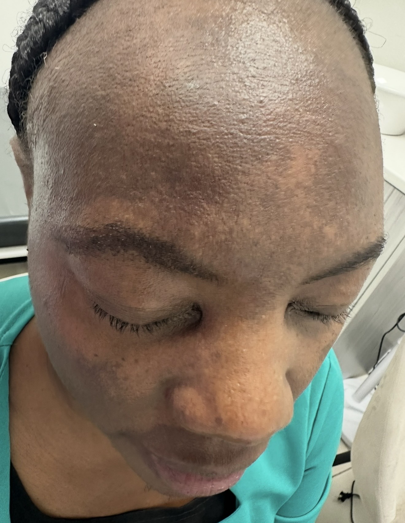 Pigmentation & Melasma